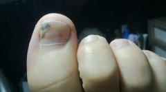 怎样治疗灰指甲？